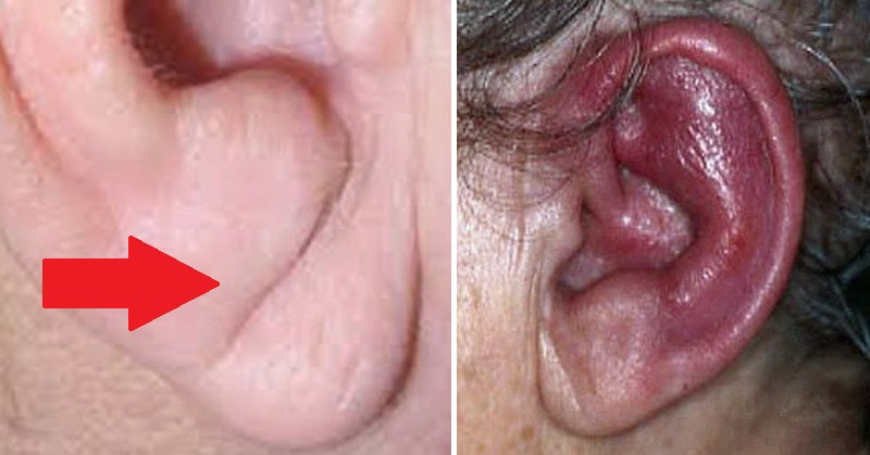 ear health FI