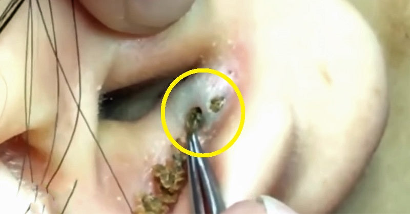 Popular Electronic Accessory Linked To Black Heads In Your Ears
