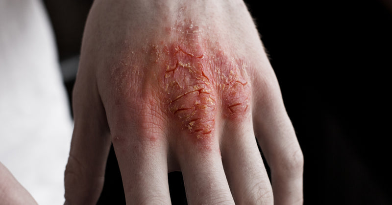 reverse eczema FI