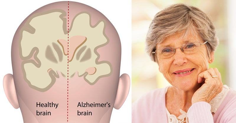eye alzheimers FI