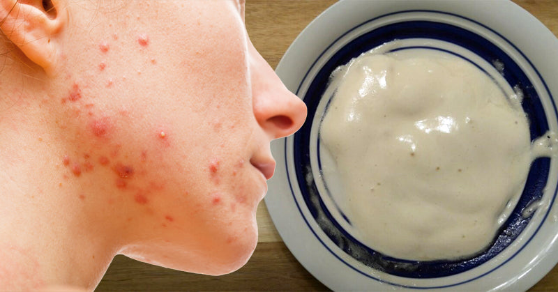 face mask acne FI