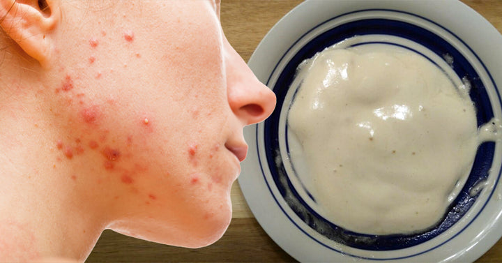 face mask acne FI