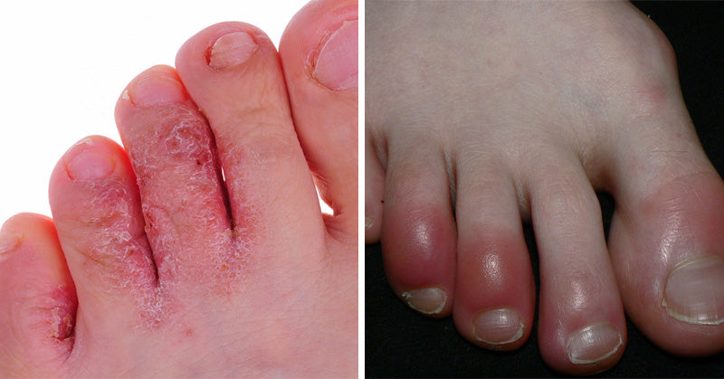 feet health FI