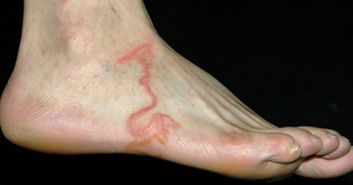 foot worm FI