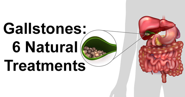 Gallstones: 6 Natural Treatments