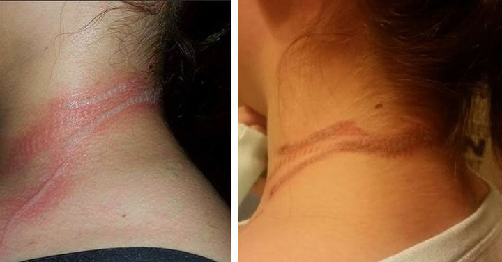 girl-neck-burn
