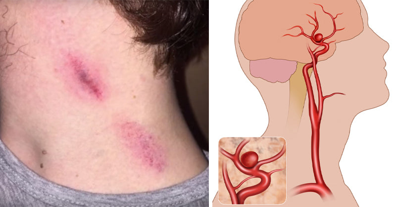 hickey death FI
