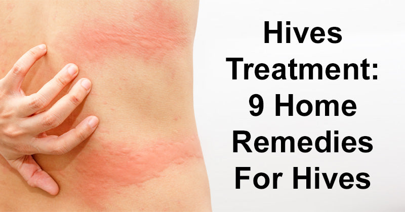 hives treatment FI