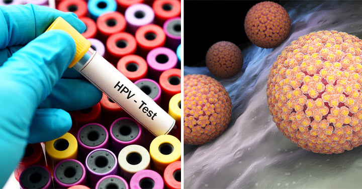 HPV Treatment: Causes, Symptoms & 4 Natural Treatments