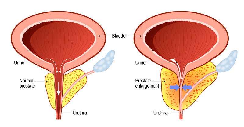 hyperplasia FI
