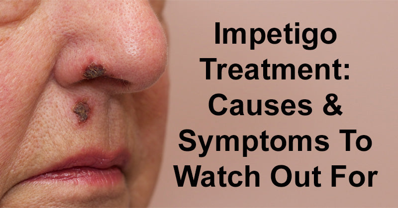 Impetigo Treatment: Causes & Symptoms To Watch Out For