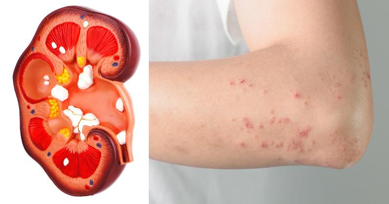 kidney damage FI