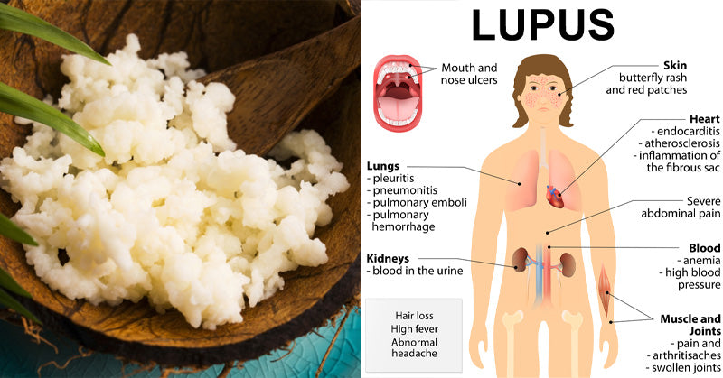 Lupus Diet: Foods To Eat & Avoid