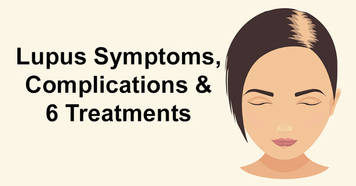 Lupus Symptoms, Complications & 6 Treatments