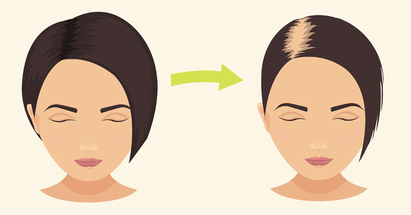 medication hair loss FI