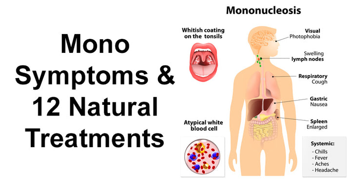 Mono Symptoms & 12 Natural Treatments