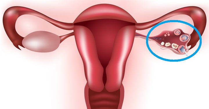 ovarian cysts FI