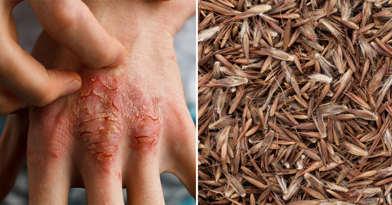 Palmarosa Essential Oil: 8 Health Uses