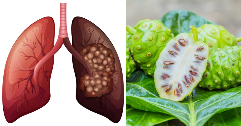 plant lung cancer FI