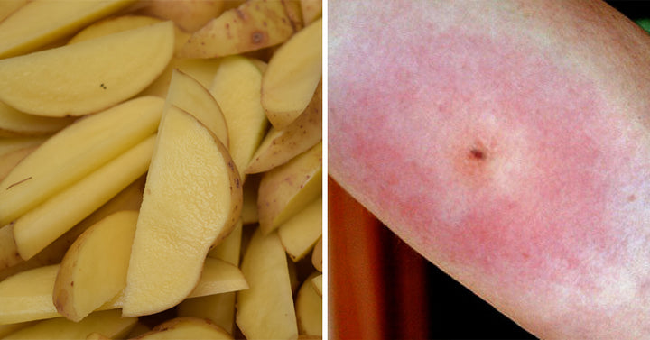 potato spider bite FI