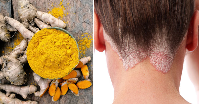 psoriasis diet FI