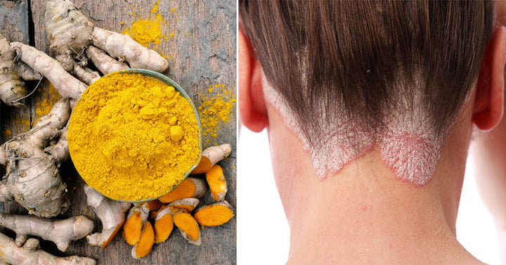 psoriasis diet FI