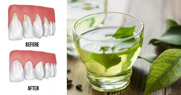 receding gums
