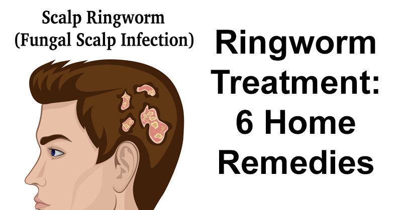 Ringworm Treatment: 6 Home Remedies