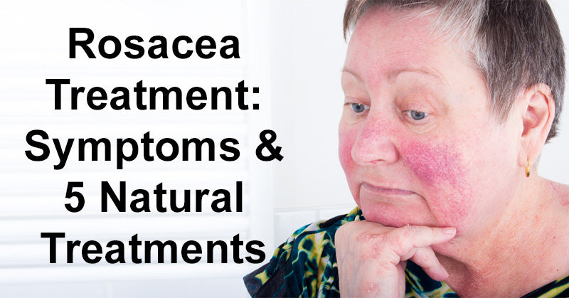 Rosacea Treatment: Symptoms & 5 Natural Treatments