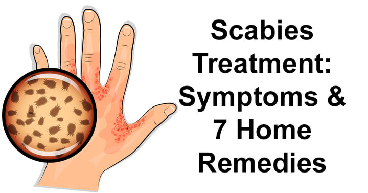 Scabies Treatment: Symptoms & 7 Home Remedies