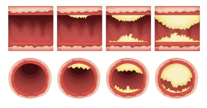 shutterstock_118550041 unclog arteries FI