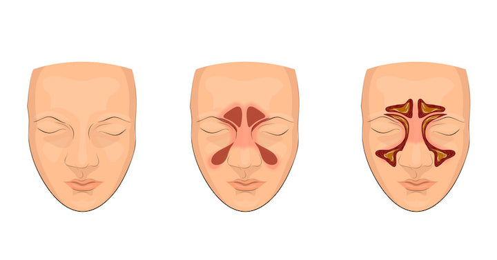 sinusitis