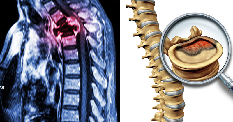 spinal cancer alkiline FI