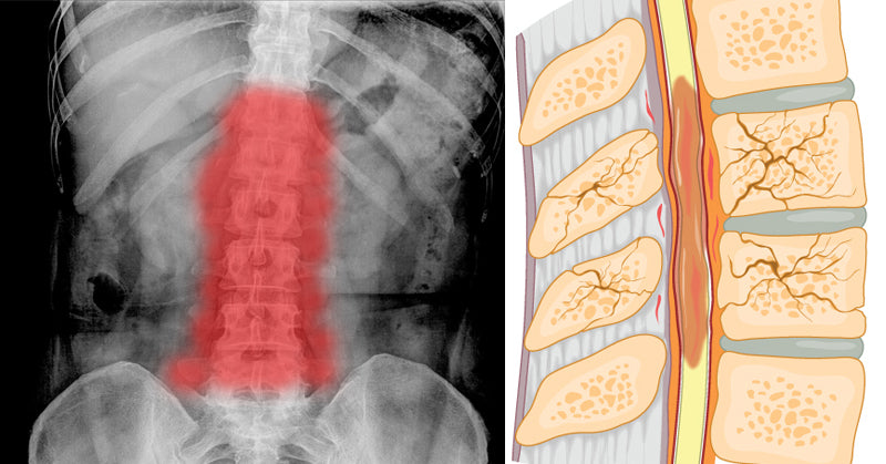 spinal injury turmeric FI