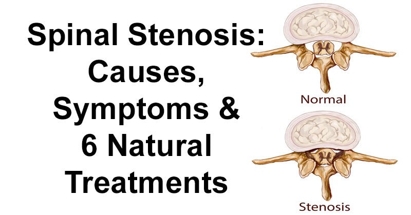 Spinal Stenosis: Causes, Symptoms & 6 Natural Treatments