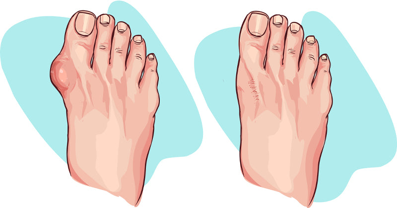stop bunions FI
