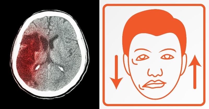 stroke FI