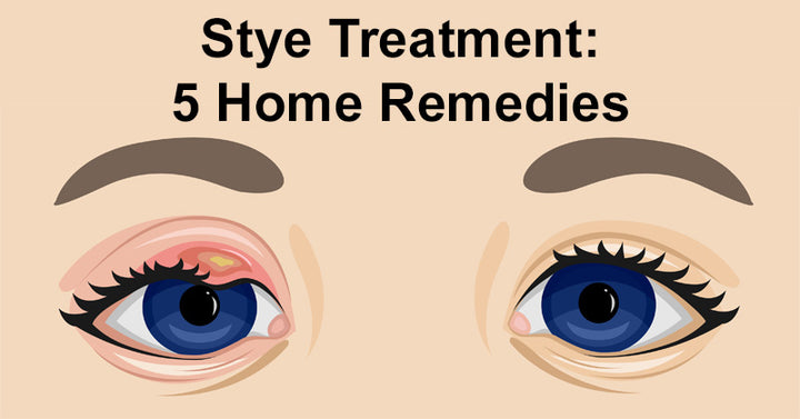 Stye Treatment: 5 Home Remedies