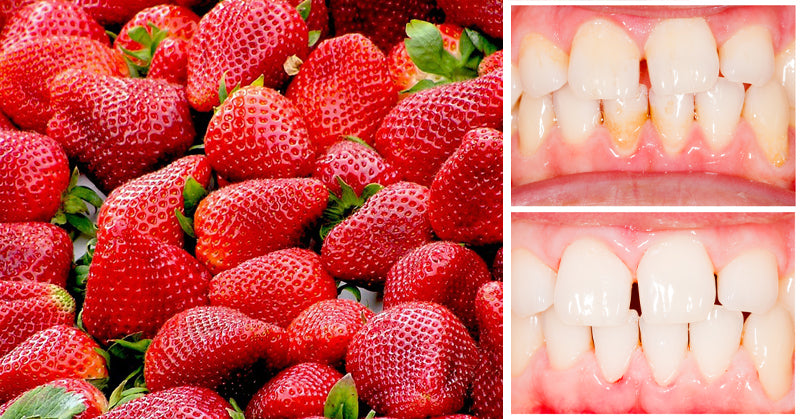 tartar teeth FI