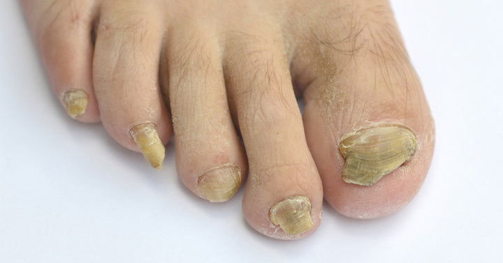 toenail fungus FI