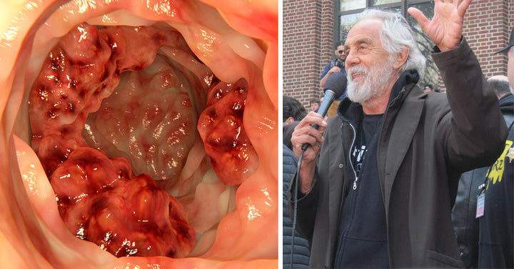 tommy chong cancer FI