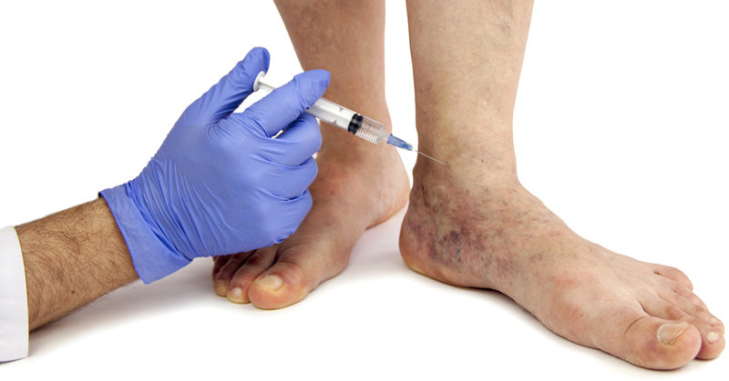 varicose-veins-remedies-fi