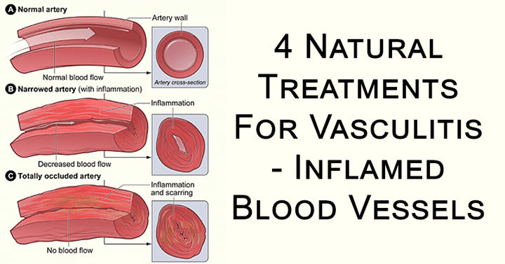 vasculitis FI