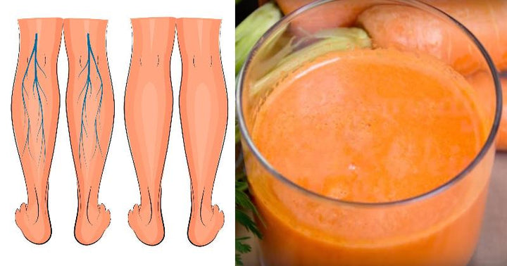 vericose veins FI