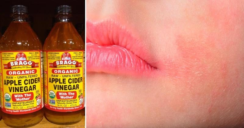 This Common Home Ingredient Will Help You Treat Eczema! - DavidWolfe.com