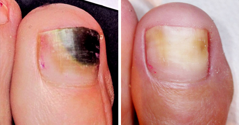 4 Natural Remedies That Cure Toenail Fungus FAST DavidWolfe